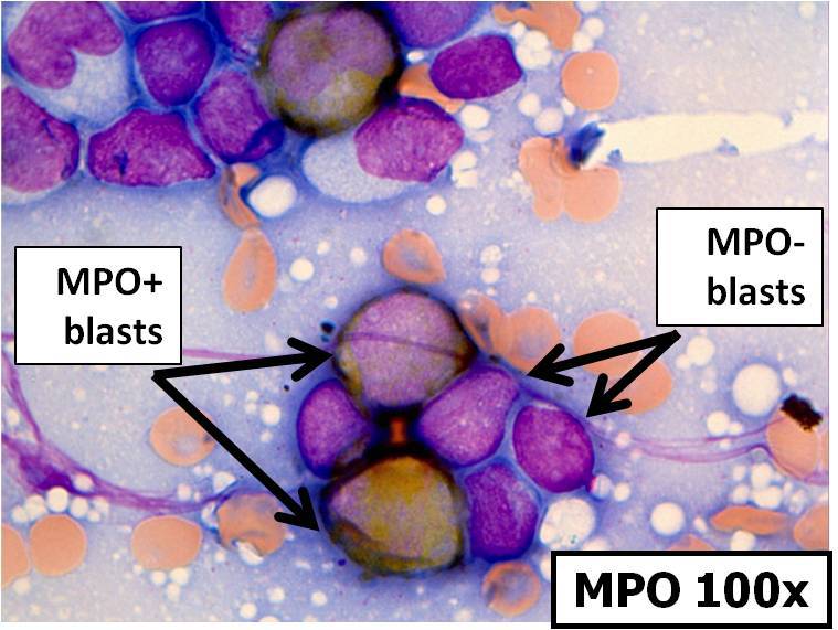 Bone marrow aspirate touch prep, MPO, 100x, showing larger blasts are MPO+ and smaller blasts are MPO-